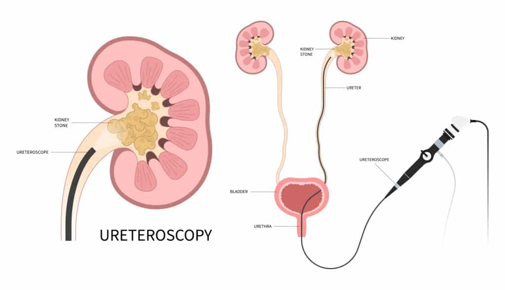 ureteroscopy laser lithotripsy