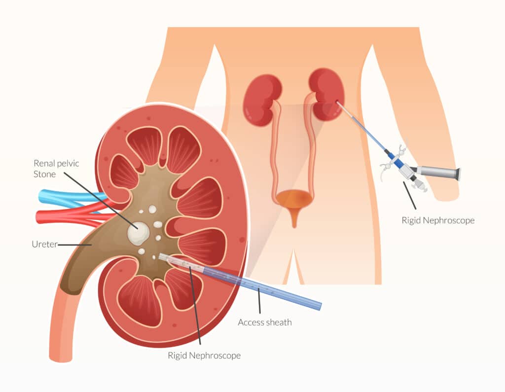 Percutaneous nephrolithotomy staghorn calculus