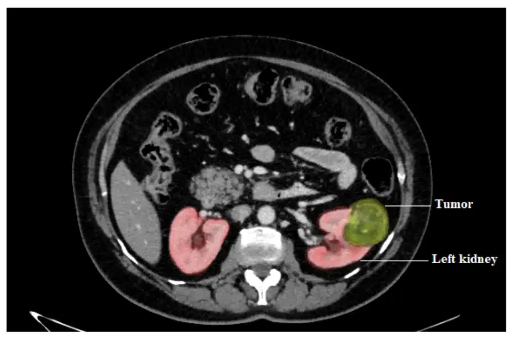 Left kidney mass for partial nephrectomy