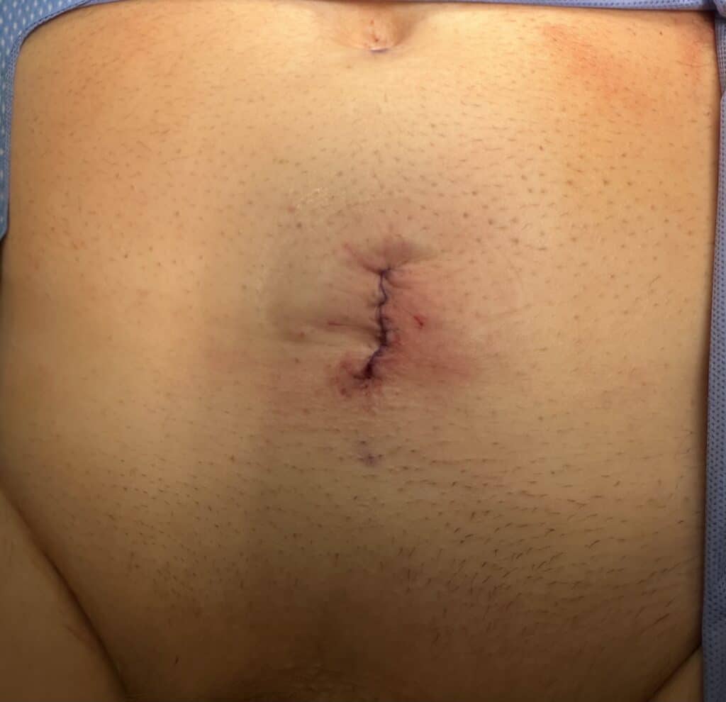 Single Port incision for a radical prostatectomy