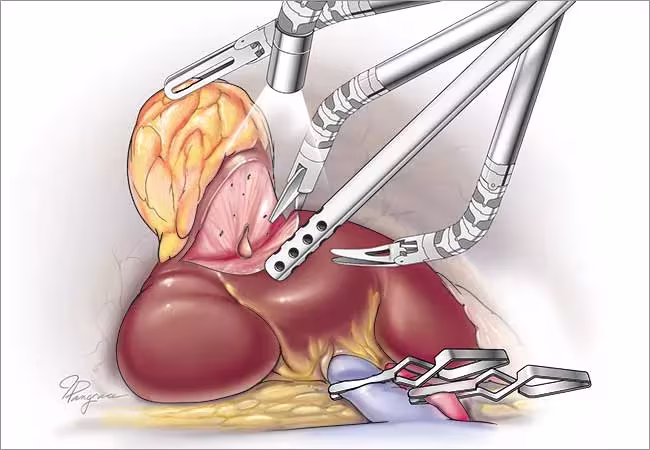 Illustration of single port partial nephrectomy