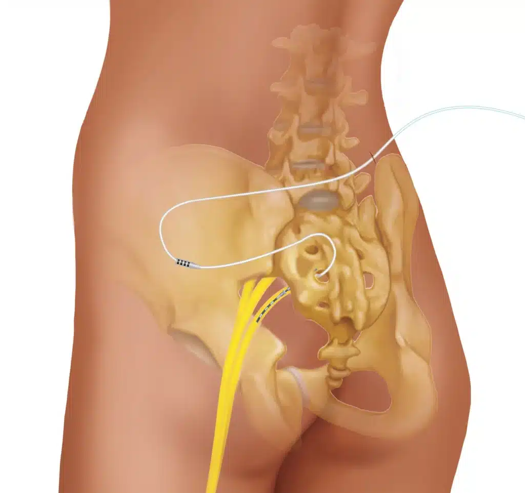 Interstim lead placement in the sacrum