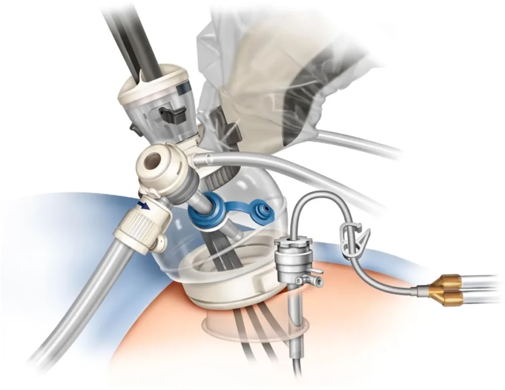 Docking system for a partial nephrectomy single port