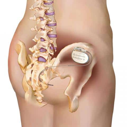 Medtronic Interstim placement