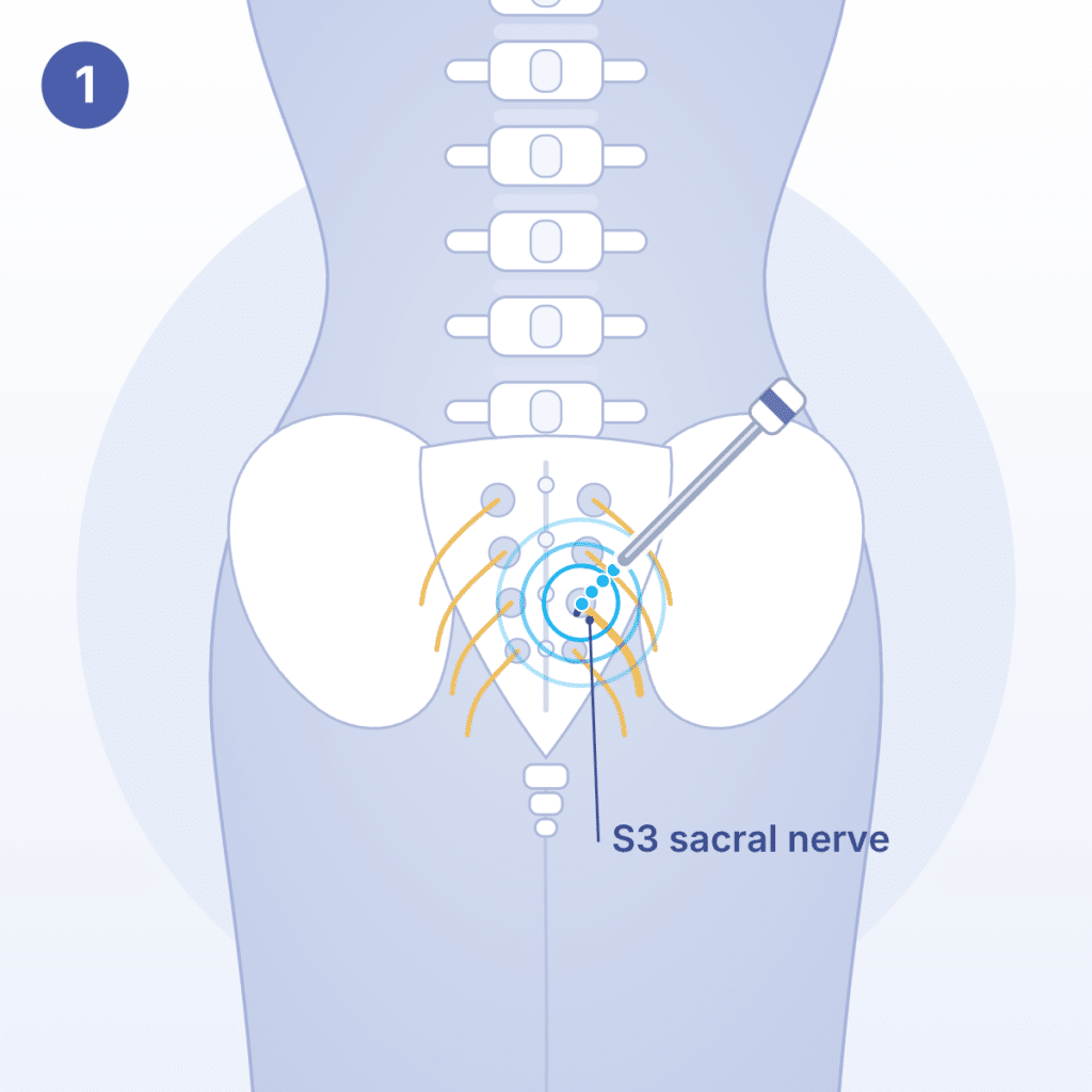 Illustration of InterStim stage 1: a thin lead is placed through the lower back next to the S3 sacral nerve in the office