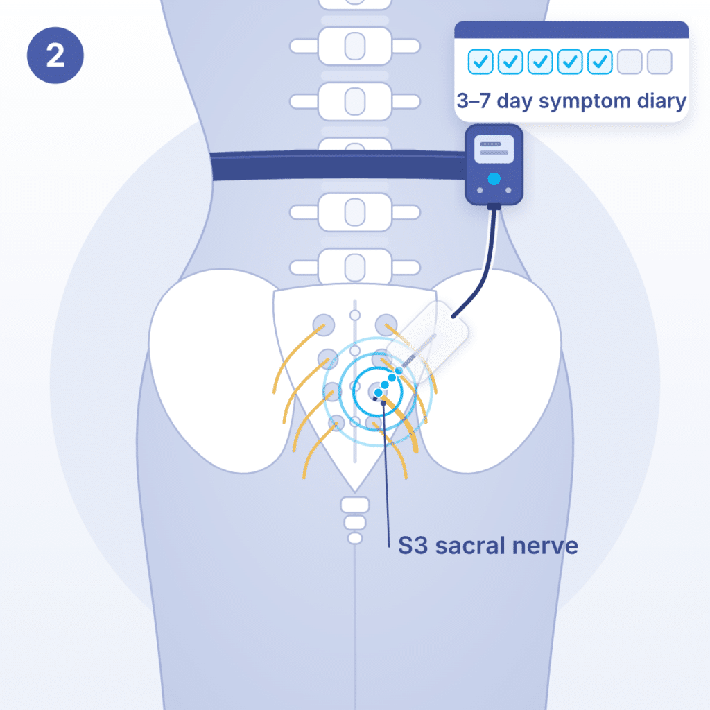 Illustration of InterStim stage 2: the temporary lead connects to a small external stimulator worn on a belt while symptoms are tracked for 3–7 days