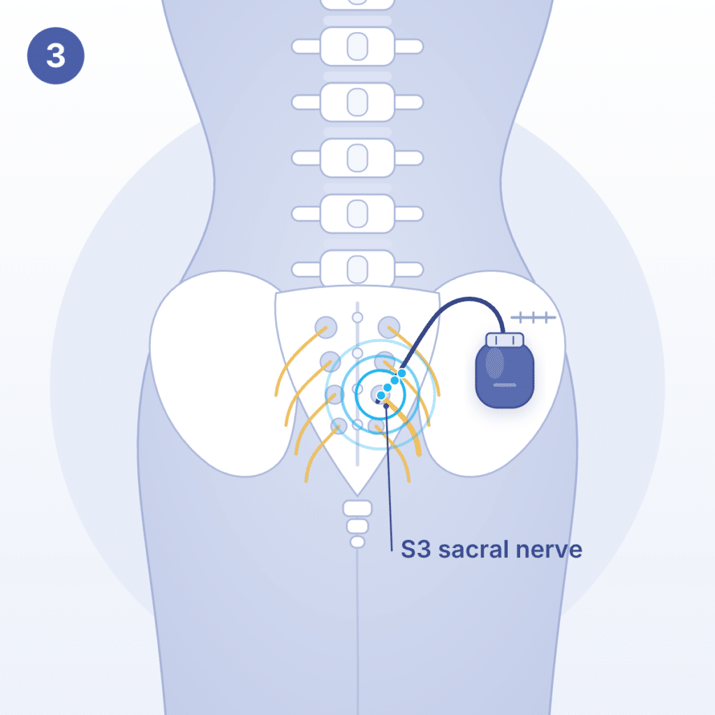 Illustration of InterStim stage 3: a small neurostimulator is implanted under the skin of the upper buttock and connected to the lead at the S3 sacral nerve