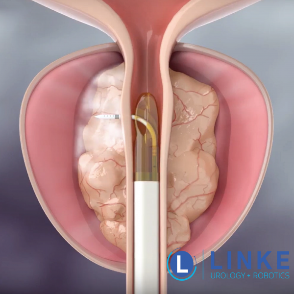 BPH & Rezūm Therapy in Fort Wayne, IN​