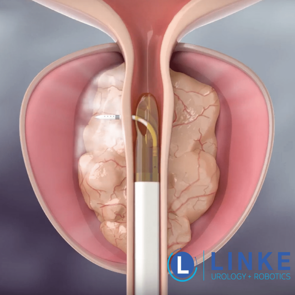 BPH & Rezūm Therapy in Fort Wayne, IN​
